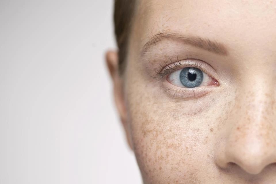 Understanding Sun Damage: How UV Rays Alter Skin and How CryoPen Can Reverse It Wellingborough