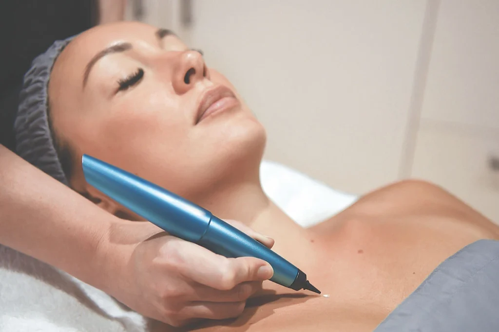 What is CryoPen Technology Wellingborough? Wellingborough