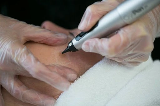 The CryoPen Technology Explained: How Extreme Cold Removes Sun-Damaged Skin Cells Wellingborough