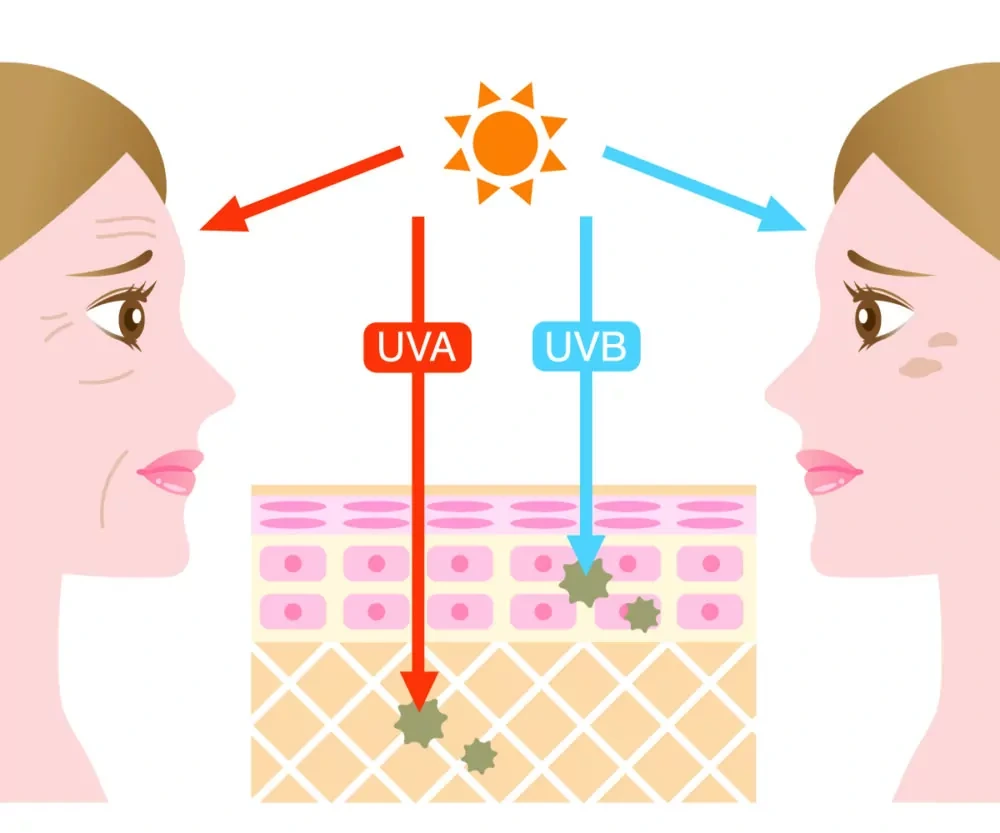 Understanding Sun Damage Wellingborough - Why Should Sun Damage Be Treated Early? Wellingborough